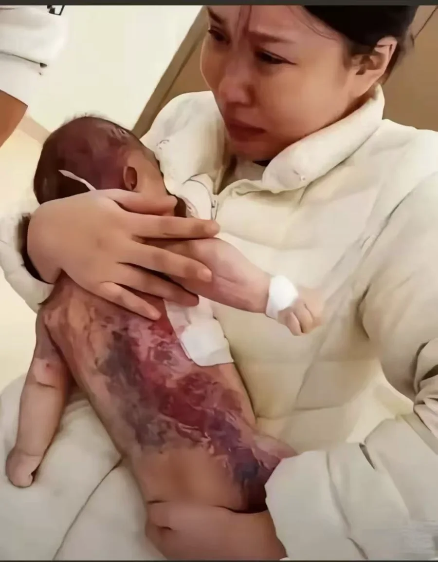 妈妈邓蓉蓉抱着已经离世的小洛熙。孩子仰面躺在她臂弯里，从后背到腰臀大片暗紫色瘀伤，手腕上还戴着住院手环；妈妈低头看着她，满脸是泪